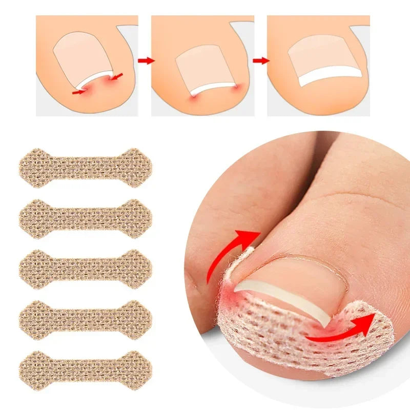 40/100pcs Ingrown Toenail Correction Stickers – Nail Care Patches for Pedicure Treatment & Recovery